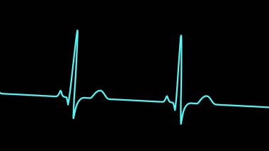 P-pulmonale, 3D illüstrasyon ECG 'yi gösteriyor, sağ atriyal aktivasyon modeliyle tutarlı olarak yüksek P dalgaları var..