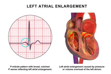 P-mitrale ile sol atriyal genişleme, genişlemiş sol atriyumu gösteren 3 boyutlu illüstrasyon ECG geniş çentik P-mitrale desenli P dalgaları.