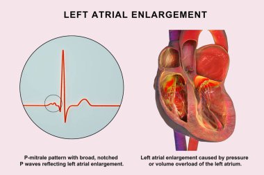 P-mitrale ile sol atriyal genişleme, genişlemiş sol atriyumu gösteren 3 boyutlu illüstrasyon ECG geniş çentik P-mitrale desenli P dalgaları.