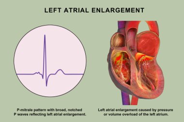 P-mitrale ile sol atriyal genişleme, genişlemiş sol atriyumu gösteren 3 boyutlu illüstrasyon ECG geniş çentik P-mitrale desenli P dalgaları.