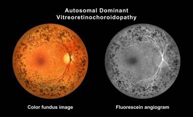 Otozomal baskın vitreoretinokoroidopati, illüstrasyon renk fundus ve florasan anjiyo görüntüsünü periferik retina atrofisi, pigmenter değişimleri ve anormal koroidal floresans göstermektedir..
