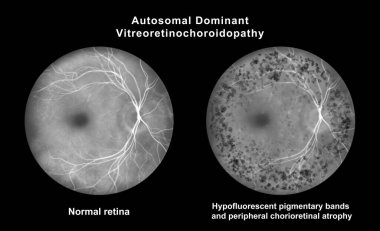 Retinasında mikroanevrizma, retinoskopi görüşünde küçük odak damar genişlemeleri, diyabetik retinopati ve hipertansif retinopati var..