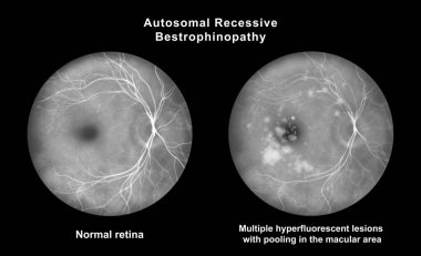 Retinasında mikroanevrizma, retinoskopi görüşünde küçük odak damar genişlemeleri, diyabetik retinopati ve hipertansif retinopati var..