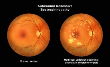 Retinasında mikroanevrizma, retinoskopi görüşünde küçük odak damar genişlemeleri, diyabetik retinopati ve hipertansif retinopati var..