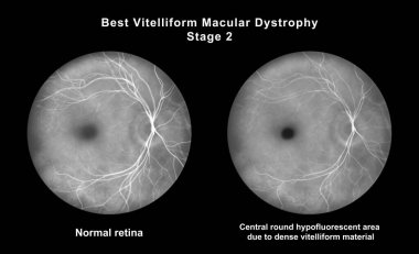 Retinasında mikroanevrizma, retinoskopi görüşünde küçük odak damar genişlemeleri, diyabetik retinopati ve hipertansif retinopati var..