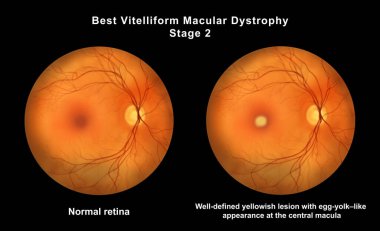 Retinasında mikroanevrizma, retinoskopi görüşünde küçük odak damar genişlemeleri, diyabetik retinopati ve hipertansif retinopati var..