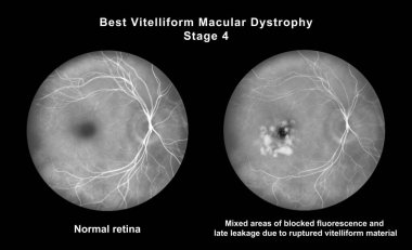 Retinasında mikroanevrizma, retinoskopi görüşünde küçük odak damar genişlemeleri, diyabetik retinopati ve hipertansif retinopati var..