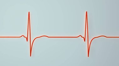 Sağ ventriküler hipertrofi, ECG 'nin V5-V6' yı R-dalga genişliği ve S dalgaları ile gösterdiğini gösteriyor..