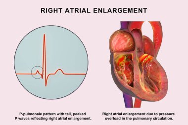 P-pulmonale ile sağ atriyal genişleme, ECG uzunluğunda P-pulmonale deseninde P dalgaları ile genişletilmiş sağ atriyumu gösteren 3 boyutlu illüstrasyon.