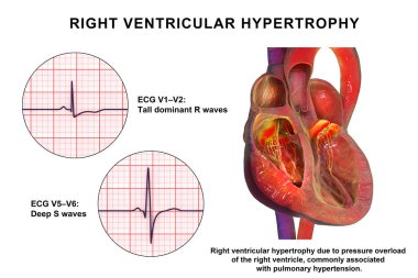 Sağ ventriküler hipertrop, sağ ventriküler miyokardiyum kalınlığı ve ECG örnekleri V1-V2 ve V5-V6 karakteristik gerilim değişimlerini gösteriyor..