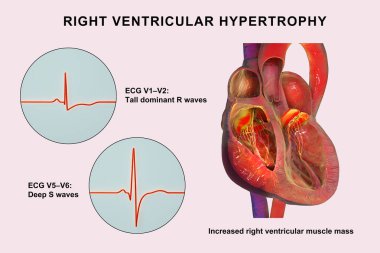 Sağ ventriküler hipertrop, sağ ventriküler miyokardiyum kalınlığı ve ECG örnekleri V1-V2 ve V5-V6 karakteristik gerilim değişimlerini gösteriyor..