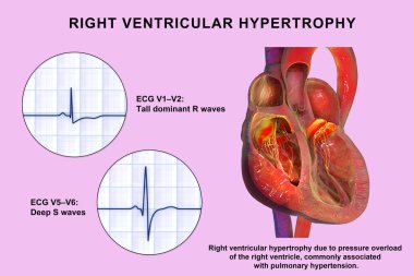 Sağ ventriküler hipertrop, sağ ventriküler miyokardiyum kalınlığı ve ECG örnekleri V1-V2 ve V5-V6 karakteristik gerilim değişimlerini gösteriyor..