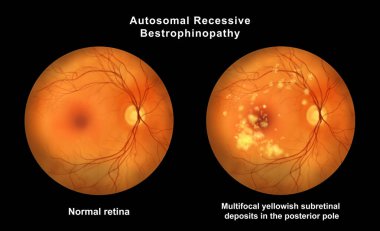 Retinasında mikroanevrizma, retinoskopi görüşünde küçük odak damar genişlemeleri, diyabetik retinopati ve hipertansif retinopati var..