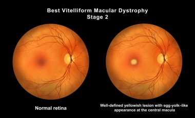 Retinasında mikroanevrizma, retinoskopi görüşünde küçük odak damar genişlemeleri, diyabetik retinopati ve hipertansif retinopati var..