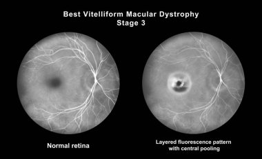 Retinasında mikroanevrizma, retinoskopi görüşünde küçük odak damar genişlemeleri, diyabetik retinopati ve hipertansif retinopati var..