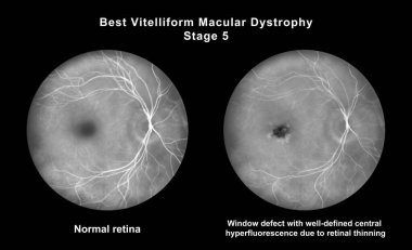 Retinasında mikroanevrizma, retinoskopi görüşünde küçük odak damar genişlemeleri, diyabetik retinopati ve hipertansif retinopati var..