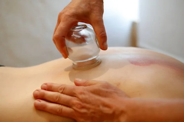 Traditional chinese medecine. Cupping therapy. Woman receving fire cupping.