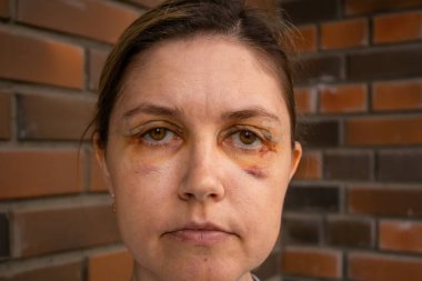 Çift Göz Cerrahisi, Göz Cerrahisi Kurtarma Dönemi, estetik ameliyattan hemen sonra. Göz Kapağı Ameliyatından Sonra Gözler