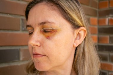 Çift Göz Cerrahisi, Göz Cerrahisi Kurtarma Dönemi, estetik ameliyattan hemen sonra. Göz Kapağı Ameliyatından Sonra Gözler