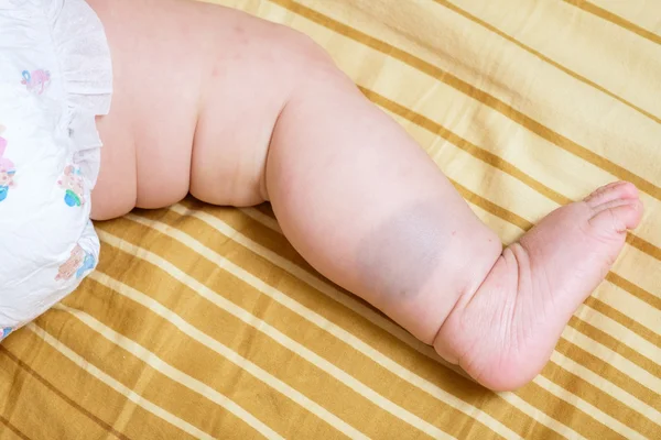 Asya bebek kız bacakları üzerinde doğum lekesi