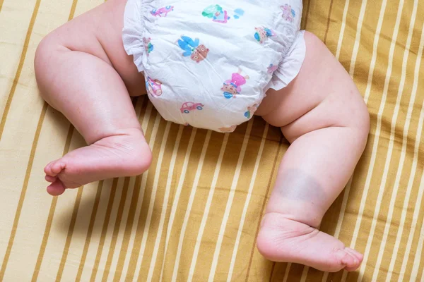 Asya bebek kız bacakları üzerinde doğum lekesi — Stok fotoğraf