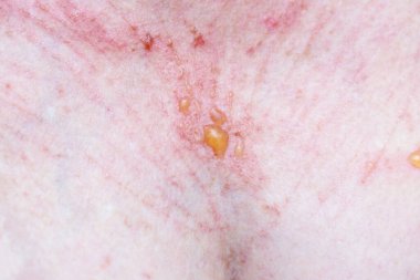 Bir sürü çizik ve küçük yanık kabarcıkları olan kadın derisi, estetik ameliyat sonrası kazalar.