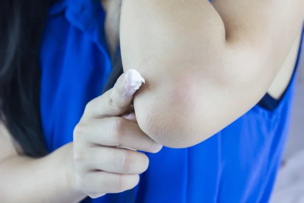 Focalizzato a gomito e lozione sul dito, le donne applicano lozione sul gomito secco — Foto Stock
