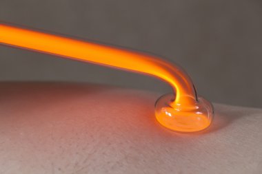 Tıbbi prosedür darsonvalization