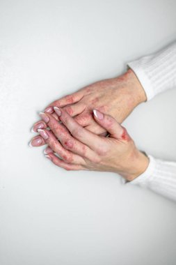 Görünür deri sorunları olan iki el beyaz bir yüzeyde dinleniyor. Kırmızı lekeler ve kuraklık egzama ve deri iltihabı gibi durumları gösteriyor. Ayarlar cilt bakımına ve iyileşmeye odaklandığını gösteriyor..