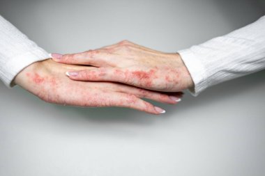 Görünür egzama ve deri tahrişi olan ellerde dermatolojik değerlendirme sırasında temas ve sedef belirtileri görülüyor. Işıklandırma cilt koşullarını vurguluyor.