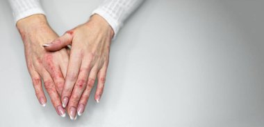 İki el pürüzsüz bir yüzeyde, egzama ve deri iltihabı belirtileri gösteriyor. Deri tahriş, kızarıklık ve soyulma gösteriyor. Bu da tedavi gerektiren bir deri bozukluğunu gösteriyor..