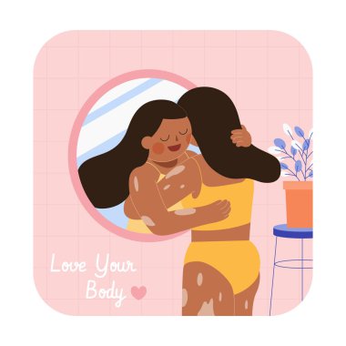 Vitiligo 'lu kadın aynada kendine sarılıyor. Düz illüstrasyon, Dünya Vitiligo Günü konsepti ve vücut pozitifliği.
