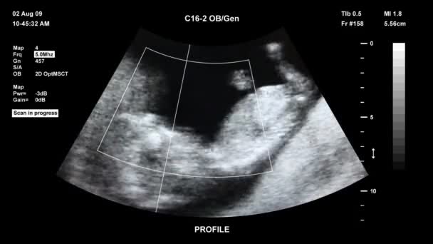 超声波扫描的人类胚胎 — 图库视频影像