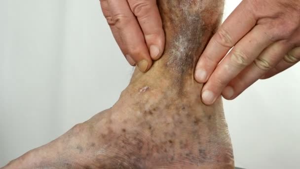 Ludzkie dłonie dotykają i kruszą obolałą plamistą nogę osoby cierpiącej na blokadę żył, owrzodzenia, zapalenie skóry, wyprysk lub inne choroby zakaźne dermatologii. Zbliżenie. — Wideo stockowe