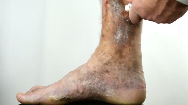 Tangan manusia grease dengan salep sakit kaki spotty orang, menderita penyumbatan pembuluh darah, borok, dermatitis, eksim atau lainnya infeksi penyakit dermatologi. Close-up. — Stok Video