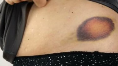 Yaşlı bir kadının elleri mor morluğu ya da hematomu inceler ve parmaklarıyla dokunur. Aile içi şiddetten ya da yaralanmadan kaynaklanan deri altı travması. Yakın plan..