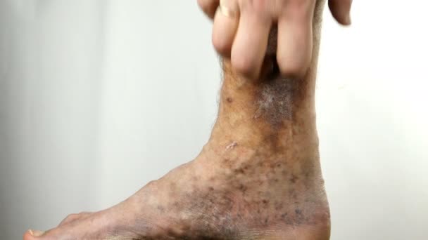 Lidské ruce poškrábat bolavé skvrnité nohy osoby trpící ucpání žil, vředy, dermatitida, ekzém nebo jiné infekční onemocnění dermatologie. — Stock video