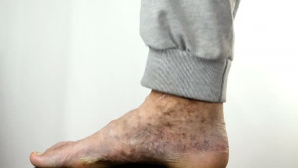 Mal à la jambe de la personne, souffrant de blocage des veines, d'ulcères, de dermatite, d'eczéma. — Video