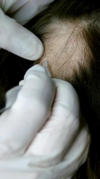 Vrouwelijke haaruitval. Dokter of cosmetoloog doet inspectie, maakt procedures, hoofd van de vrouw op de huid waarvan er geen haar. Alopecia areata, lichen, trichopetia, microsporia.Verticaal formaat. — Stockvideo