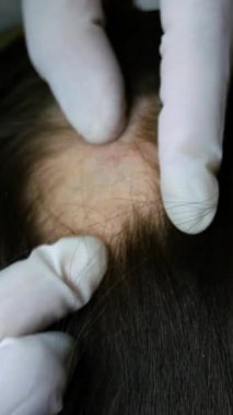 Kadın saç dökülmesi. Doktor ya da kozmetikçi muayene eder, prosedürler yapar, saç olmayan kadın derisinin başı. Alopecia areata, lichen, trichopetia, microsporia. Dikey format.