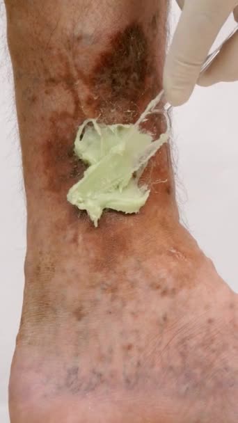 Sore spotty leg of person suffering from blockage of veins, ulcers, dermatitis, eczema or other infectious diseases of dermatology. Vertical format. — Stock Video