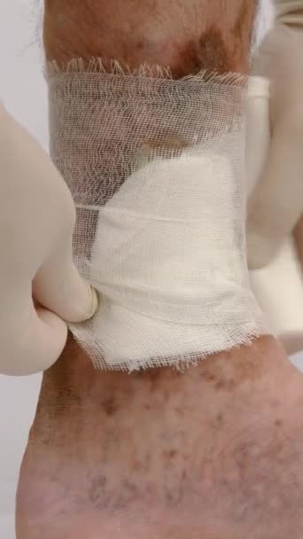 Wunde fleckige Bein der Person, die an Verstopfung von Venen, Geschwüren, Dermatitis, Ekzemen oder anderen Infektionskrankheiten der Dermatologie leiden. Vertikales Format. — Stockvideo