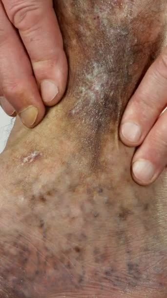 Ludzkie dłonie dotykają i kruszą obolałą plamistą nogę osoby cierpiącej na blokadę żył, owrzodzenia, zapalenie skóry, wyprysk lub inne choroby zakaźne dermatologii. Pionowe wideo. Zbliżenie. — Wideo stockowe