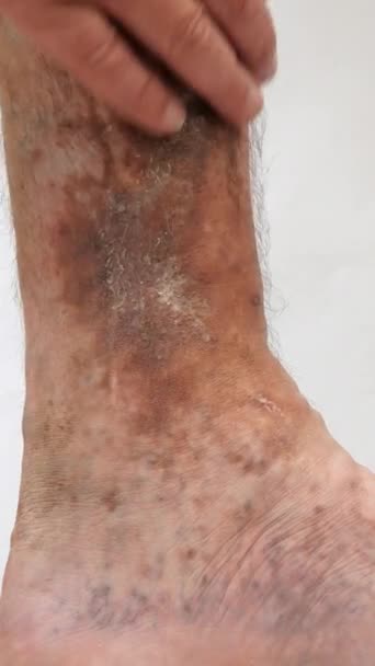 Ludzkie dłonie dotykają i kruszą obolałą plamistą nogę osoby cierpiącej na blokadę żył, owrzodzenia, zapalenie skóry, wyprysk lub inne choroby zakaźne dermatologii. Zbliżenie. — Wideo stockowe