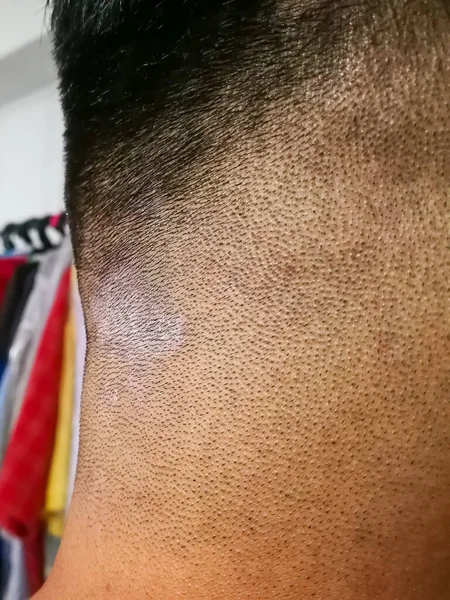 Cerrado Tiña También Conocida Como Tinea Cuero Cabelludo Cabeza Problema — Foto de Stock