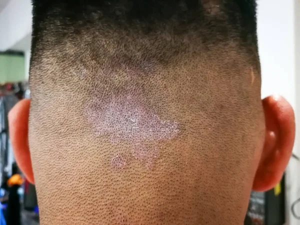 Kafa Derisinde Tinea Olarak Bilinen Mantar Solucanından Kapanmış Dermatit Problemi — Stok fotoğraf