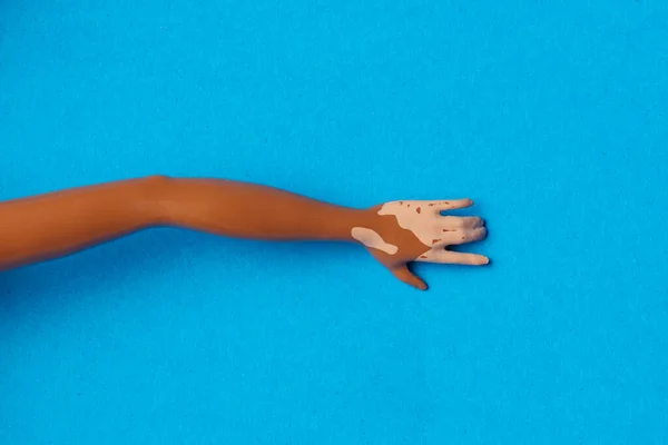 black girl doll hold hand with viteligo on blue background