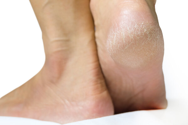 Women's heel feet dry