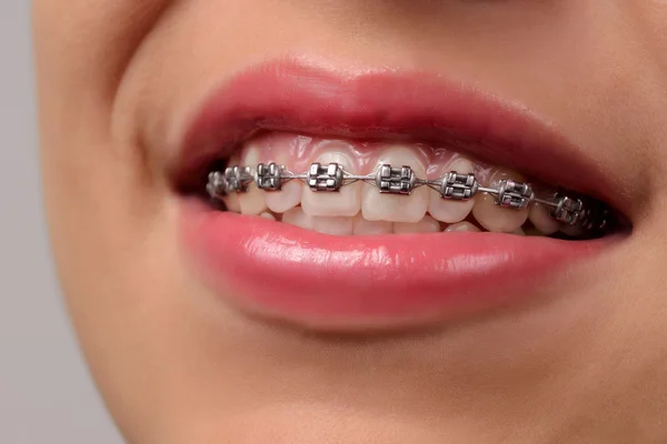 Close-up dental Braces on Teeth. — Stock Photo, Image