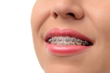 Healthy smile - teeth with dental braces clipart